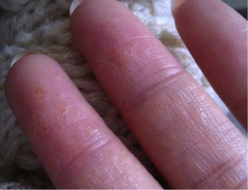 中西醫鵝掌風怎樣治療，預防手癬的方法