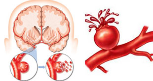 秋冬交替 中老年人謹防腦中風
